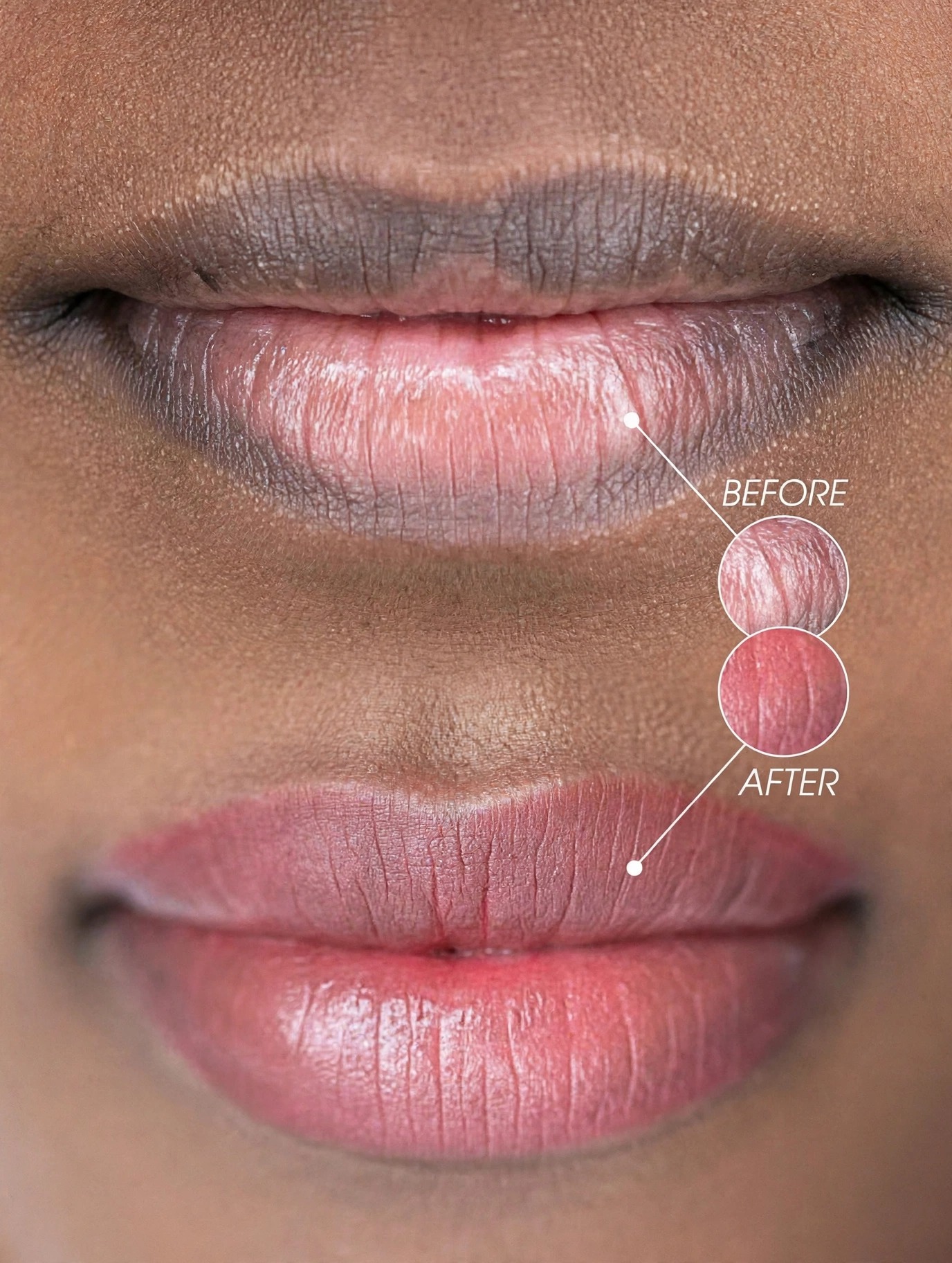 Lips Neutralization