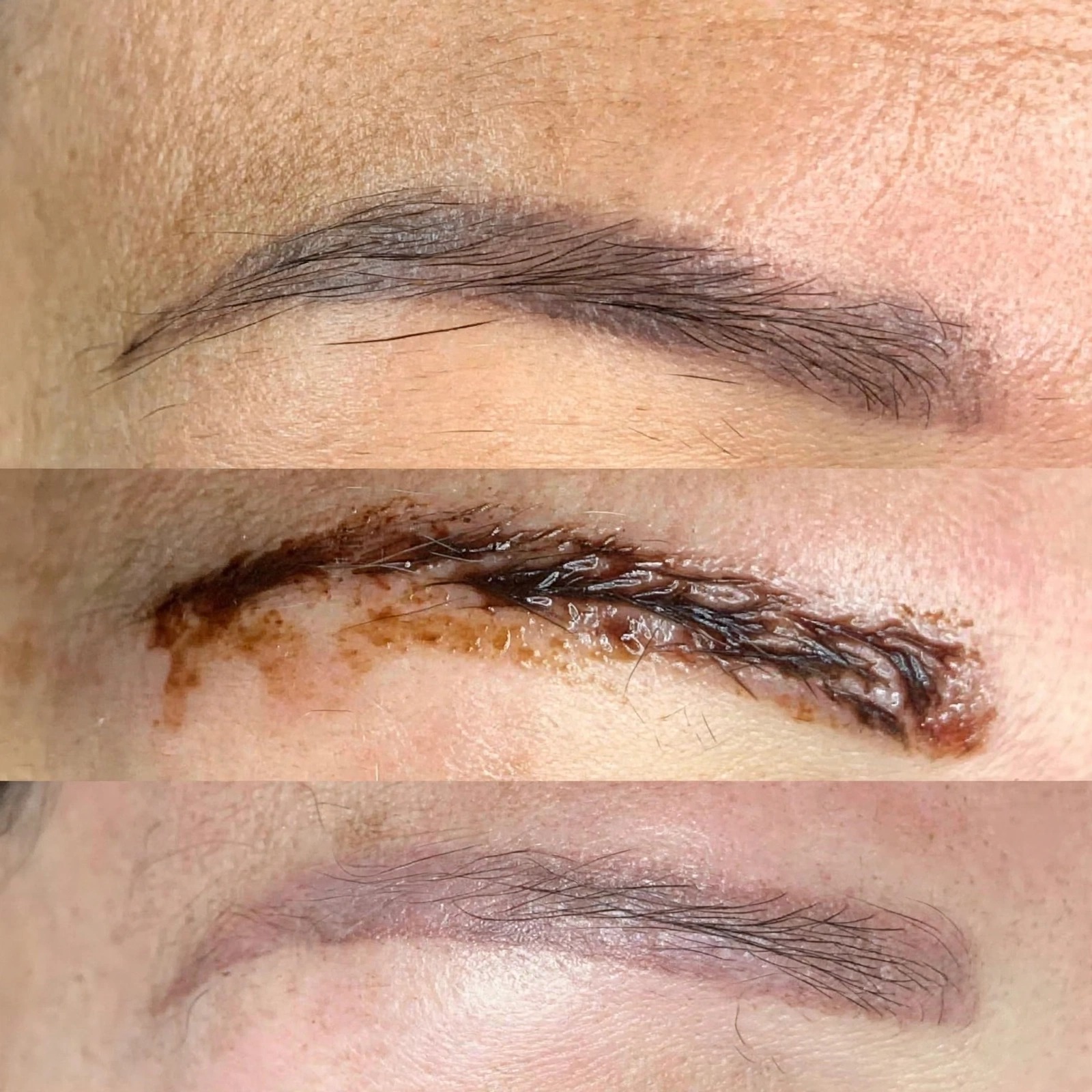 Removal-Brows